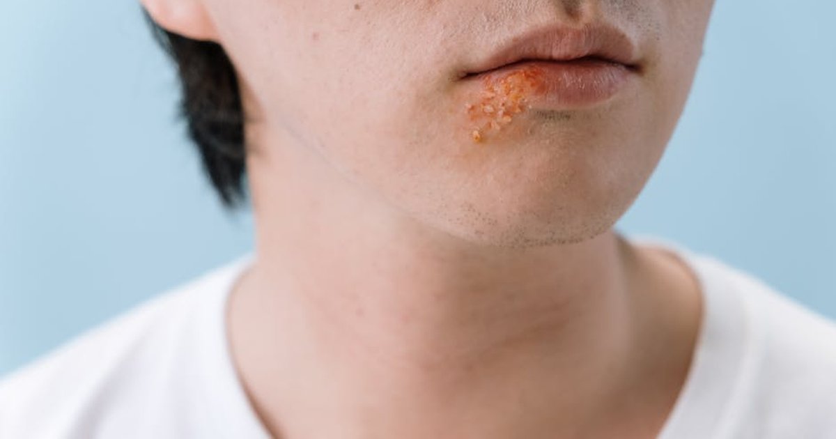 A close-up image of a person's lips showing a cold sore on the lower lip area.